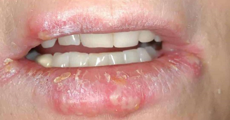 Bệnh chàm môi là một vấn đề da liễu thường gặp
