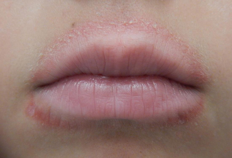 Bệnh chàm môi ở thể nhẹ thường có triệu chứng giống nẻ môi do thời tiết