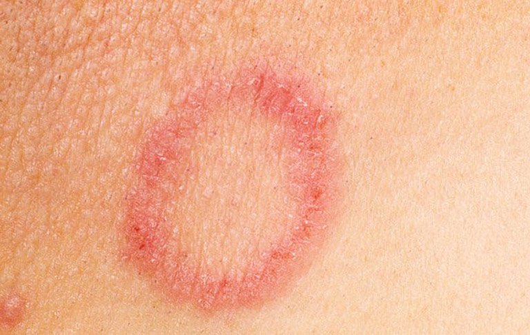 Bệnh hắc lào thường xuất hiện các vết ban trên da