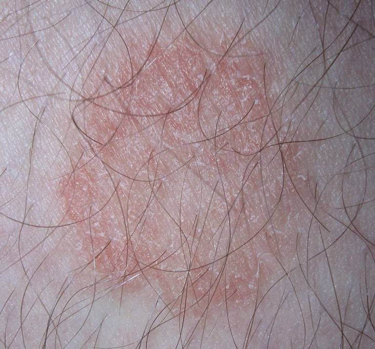 Bệnh có các dấu hiệu nhận biết khá rõ ràng trên da