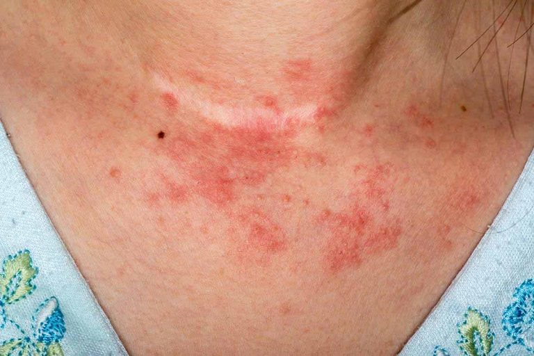 Chàm da là một trong những bệnh lý da liễu thường gặp