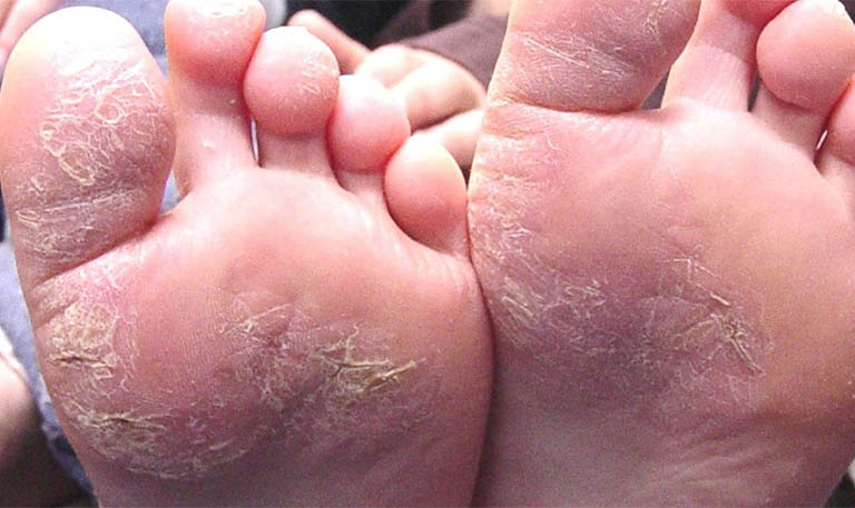 Bệnh viêm da cơ địa ở chân