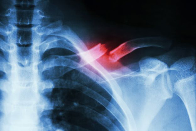 Hình ảnh chụp X quang xương đòn bị gãy