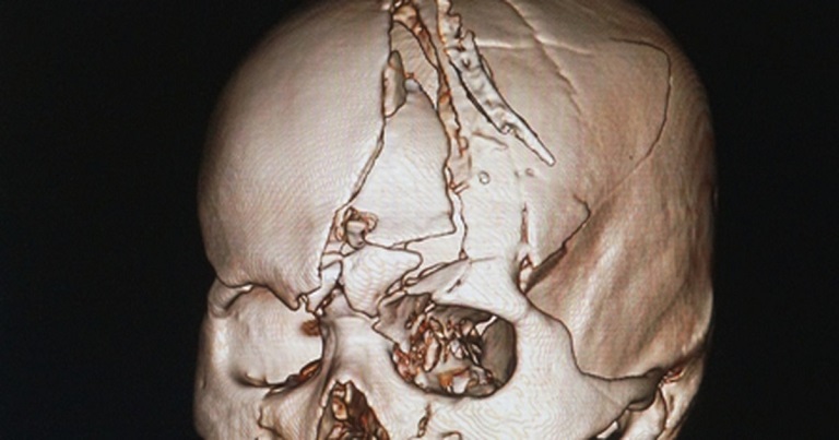 Gãy nứt xương hộp sọ là một chấn thương nghiêm trọng