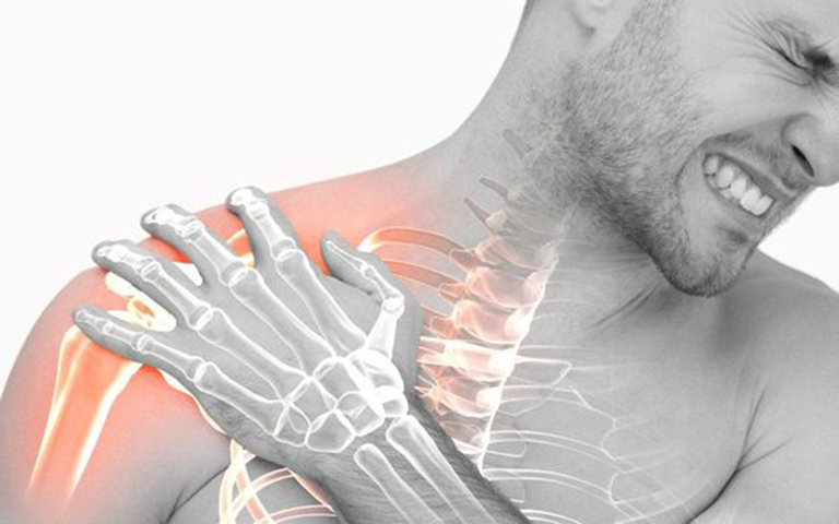 Gãy xương đòn thường gây ra các cơn đau nghiêm trọng