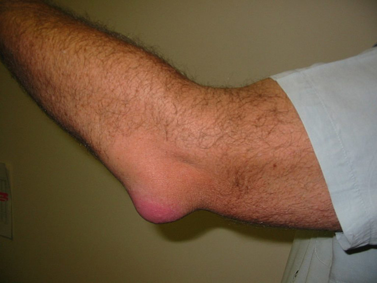 Viêm bao hoạt dịch ở cánh tay là một căn bệnh gây ra nhiều triệu chứng khó chịu 