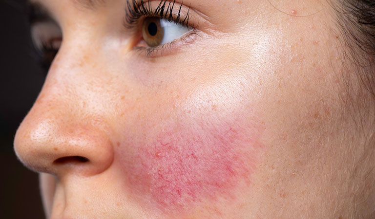 Da mặt nổi mẩn đỏ là hiện tượng khá phổ biến hiện nay