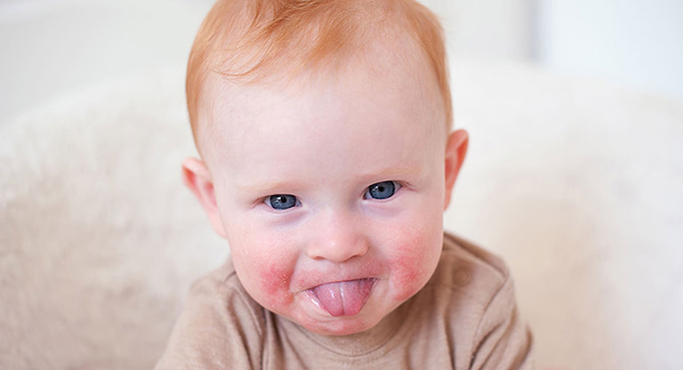 Trẻ bị lở miệng sẽ xảy ra tình trạng nổi mẩn đỏ ở xung quanh