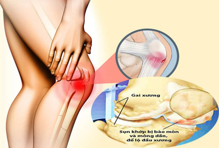 Gai xương gây ra các cơn đau nghiêm trọng