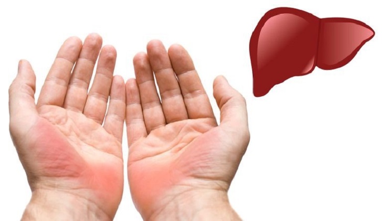 Hiện tượng lòng bàn tay nổi mẩn đỏ ngứa có thể do mắc các bệnh liên quan đến gan mật