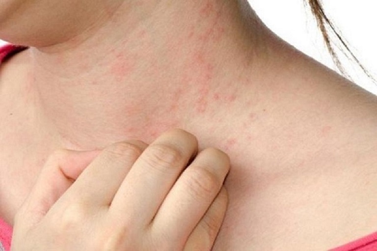 Người bệnh nên chủ động phòng ngừa hiện tượng nổi mẩn đỏ trên da tại nhà
