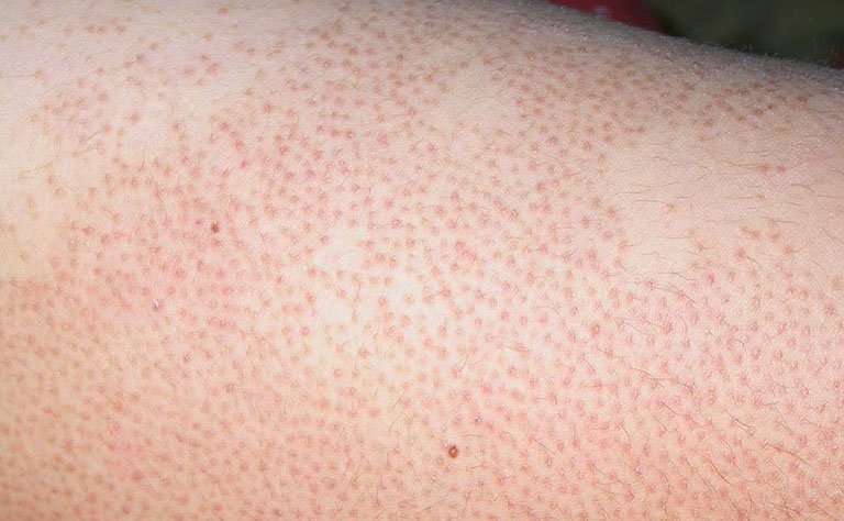 Viêm nang lông cũng có thể dẫn tới tình trạng nổi mẩn đỏ ngứa ở chân