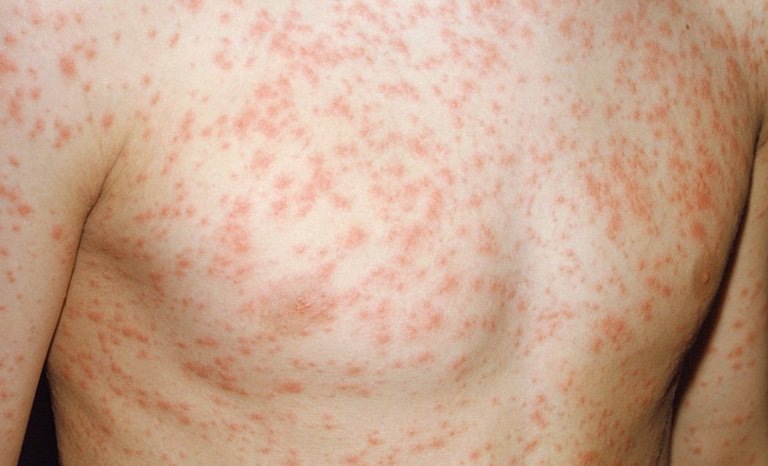 Nổi mẩn đỏ ở ngực là hiện tượng da liễu khá phổ biến mà nhiều người gặp phải
