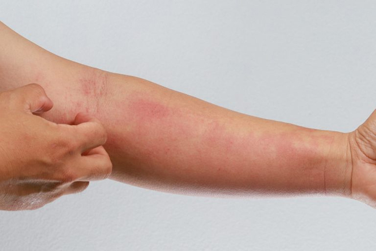 Da bị nhiễm nấm có thể là nguyên nhân gây nổi mẩn đỏ ở bàn tay.