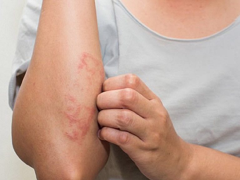 Bệnh chàm tổ đỉa cũng có thể gây nổi mẩn đỏ ở tay