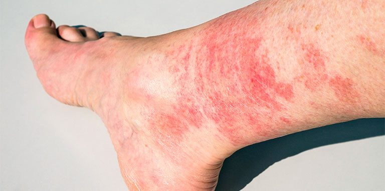 Nổi mẩn đỏ ở chân nhưng không ngứa là tình trạng nhiều người gặp phải