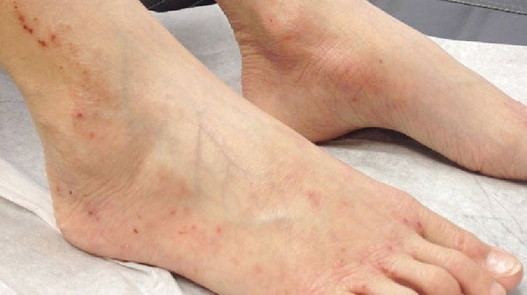 Nhiều nguyên nhân có thể gây ra tình trạng chân nổi mẩn đỏ không ngứa