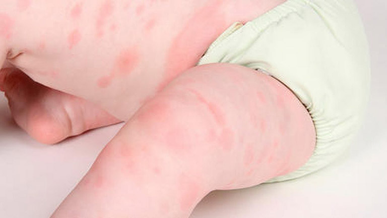 Trẻ em thuộc nhóm dễ bị sốt kèm nổi mẩn đỏ