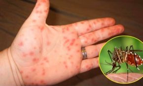 Sốt xuất huyết là căn bệnh tấn công cơ thể do virus Dengue thông qua muỗi vằn