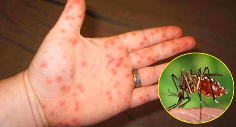 Sốt xuất huyết là căn bệnh tấn công cơ thể do virus Dengue thông qua muỗi vằn