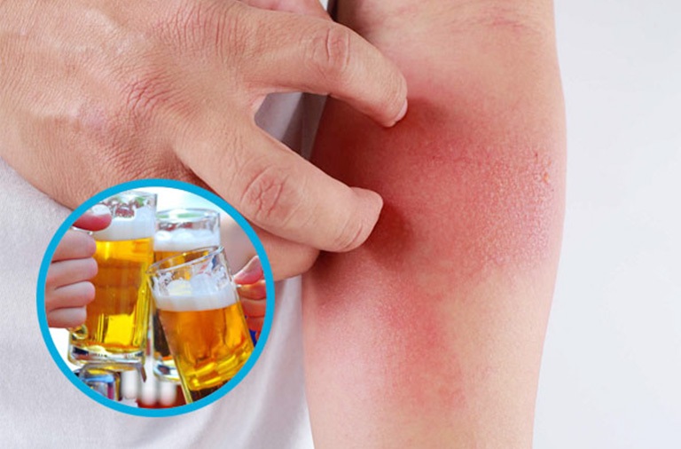 Có nhiều nguyên nhân khiến uống rượu bia bị nổi mẩn đỏ