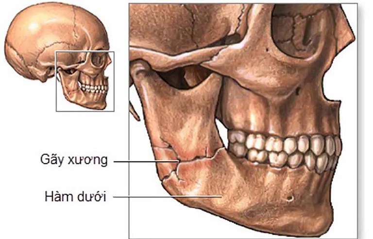 Ở xương hàm có 2 lỗ thần kinh bên trái và bên phải