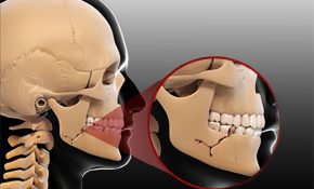 Xương quai hàm còn được gọi là xương hàm dưới,