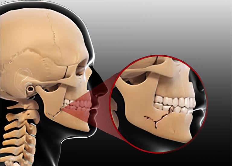 Xương quai hàm còn được gọi là xương hàm dưới,