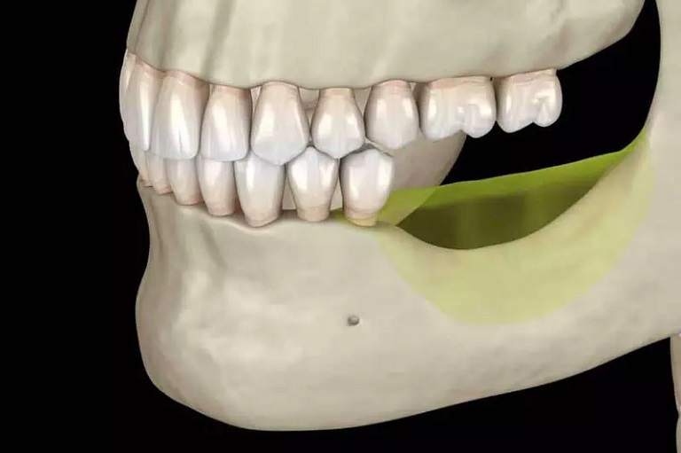 Tiêu xương hàm còn được gọi là tiêu xương ổ răng