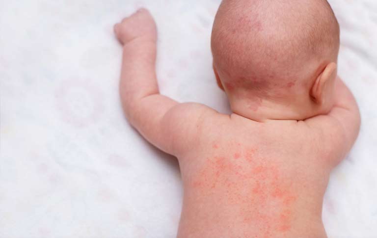 Tình trạng bé bị nổi mẩn đỏ không sốt không ngứa khá thường gặp