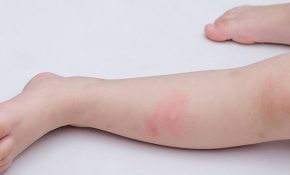 Đề kháng của da yếu cũng khiến trẻ bị nổi mẩn đỏ ở chân