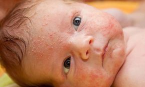 Trẻ sơ sinh bị nổi mẩn đỏ ở mặt khá thường gặp