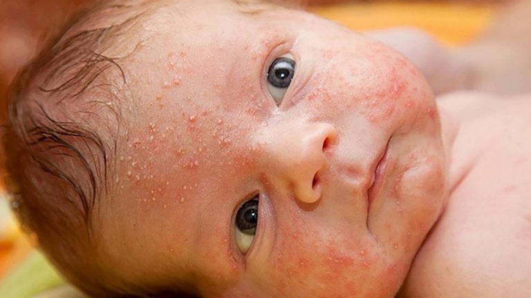 Trẻ sơ sinh bị nổi mẩn đỏ ở mặt khá thường gặp