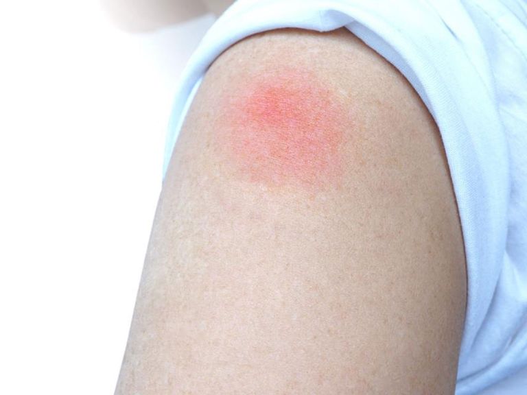 Sau tiêm vaccine nổi mẩn đỏ thường do phản ứng khi tiếp xúc với kháng thể