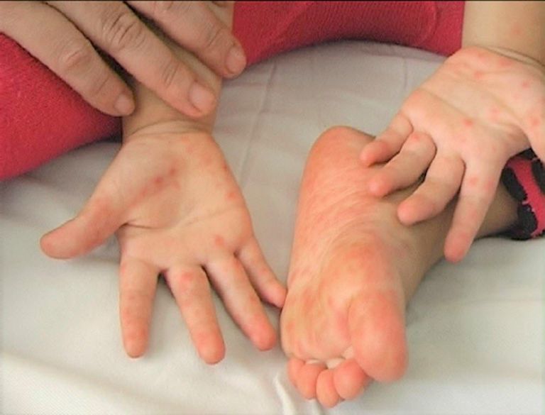 Bệnh chân tay miệng ở trẻ thường bùng phát vào mùa xuân