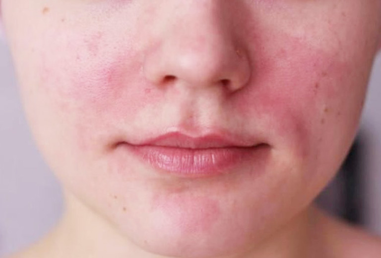 Bị dị ứng da mặt nhẹ có thể dùng nước muối để cải thiện tình trạng