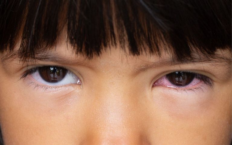 Tổng quan về hiện tượng viêm mũi dị ứng gây ngứa mắt