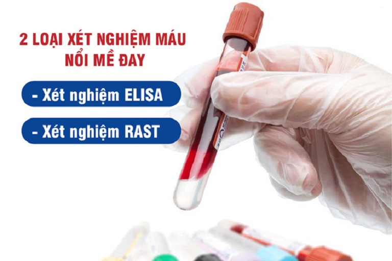 Hai loại xét nghiệm máu thường được chỉ định cho người bệnh dị ứng da