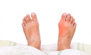 Bệnh Gout: Nguyên Nhân, Cách Điều Trị Và Phòng Ngừa Hiệu Quả