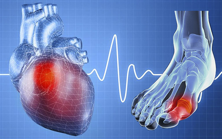 Biến chứng của gout liên quan đến hệ tim mạch